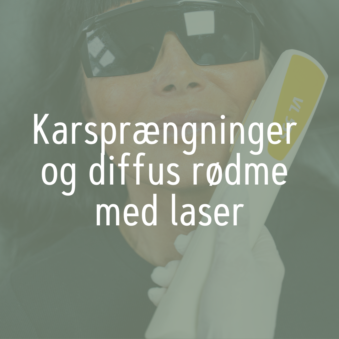 Karsprængninger og diffus rødme med laser